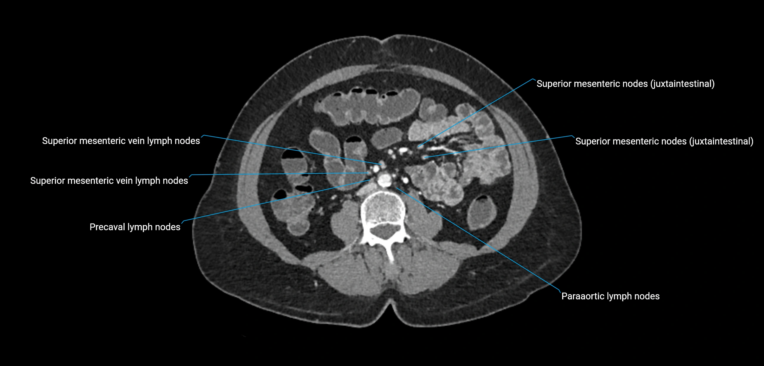 CT ct abdominal lymph nodes  axial cross sectional anatomy  enchanced radiology image -img-00002-00241.webp